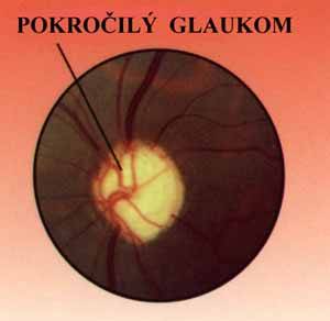 Pokročilý glaukom