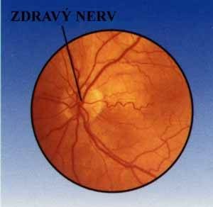 Zdravý očný nerv